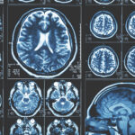 How Neuroradiology Improves Diagnosis of Sleep-Related Brain Disorders