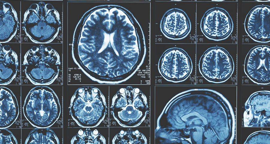 How Neuroradiology Improves Diagnosis of Sleep-Related Brain Disorders