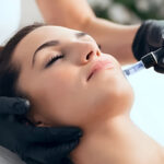 Microneedling for Post-Acne Scars: A Guide
