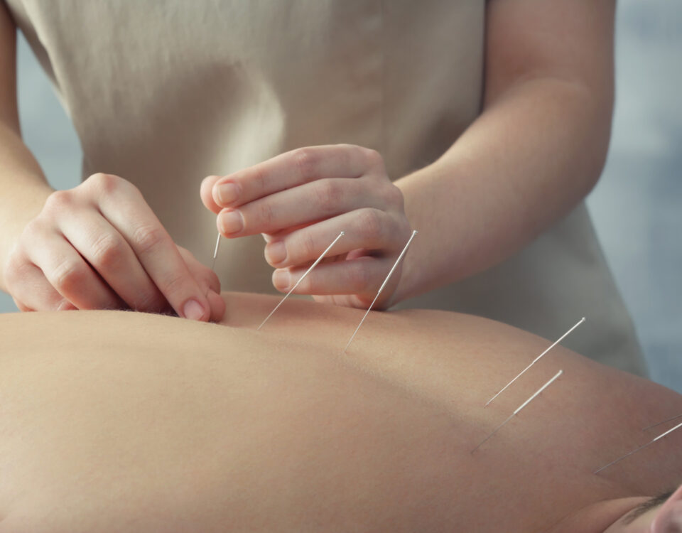 The Role of Acupuncture in Sports Injuries