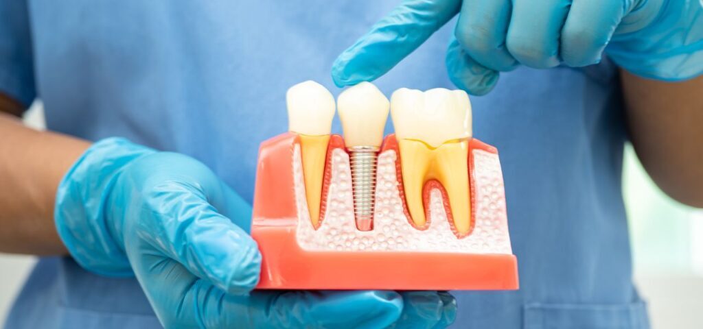 FAQs About Root Canals