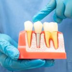 FAQs About Root Canals