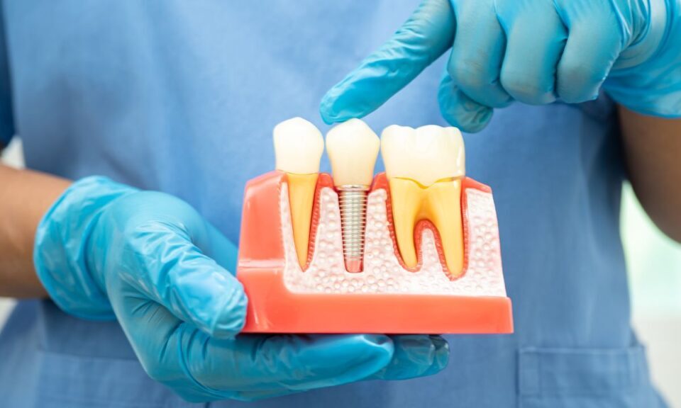 FAQs About Root Canals