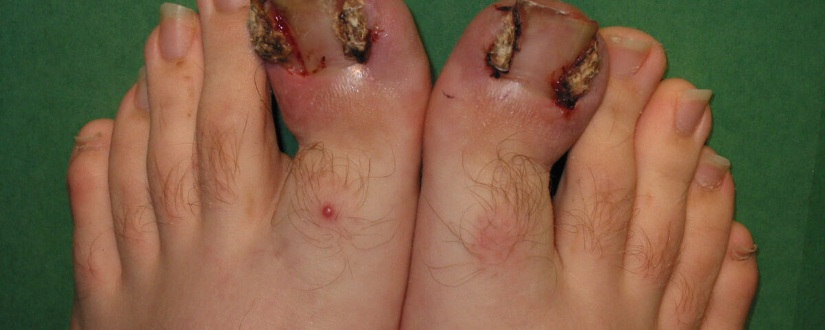 How to Avoid Ingrown Toenails This Holiday Season