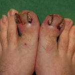 How to Avoid Ingrown Toenails This Holiday Season