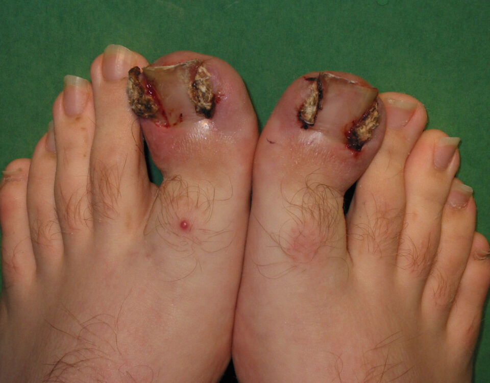 How to Avoid Ingrown Toenails This Holiday Season