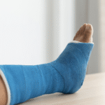 Navigating Recovery After an Ankle Fracture