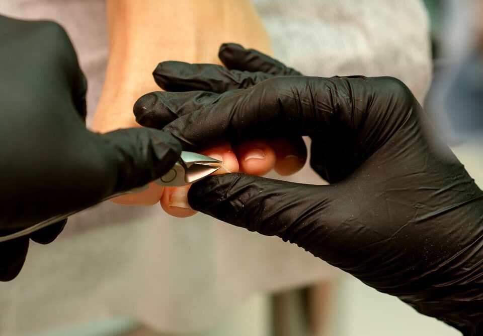 Prevention and Care Tips for Ingrown Toenails
