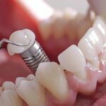 Understanding the Benefits and Risks of Dental Implants