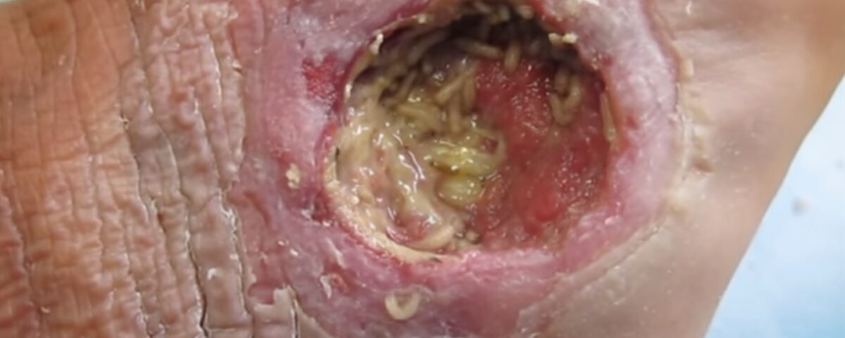 What To Expect From Ulcerative Colitis Treatments