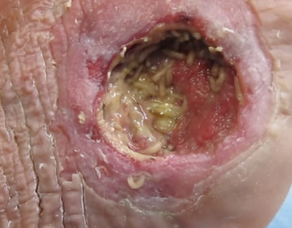 What To Expect From Ulcerative Colitis Treatments