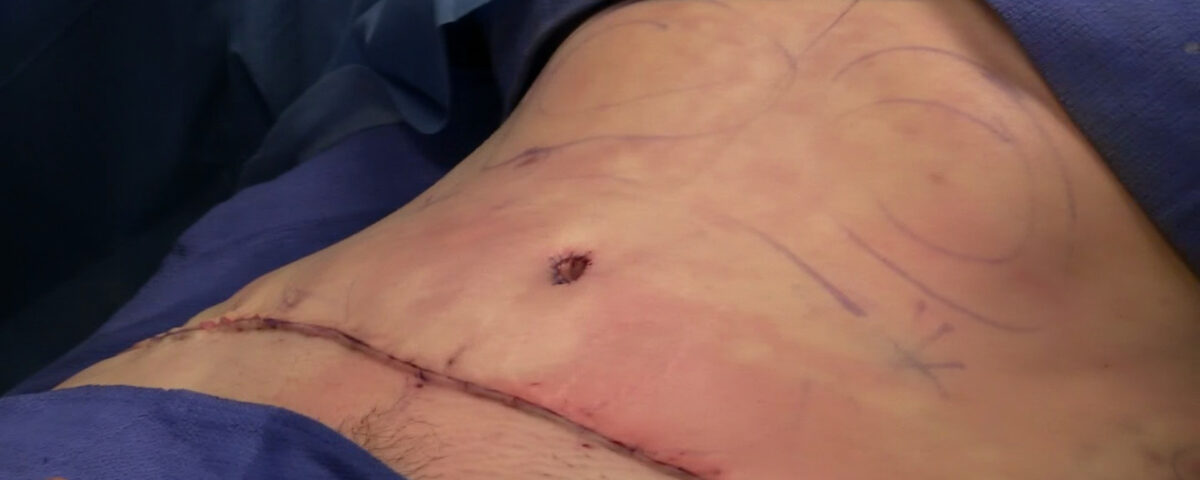 What to Expect During a Tummy Tuck Procedure