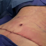 What to Expect During a Tummy Tuck Procedure