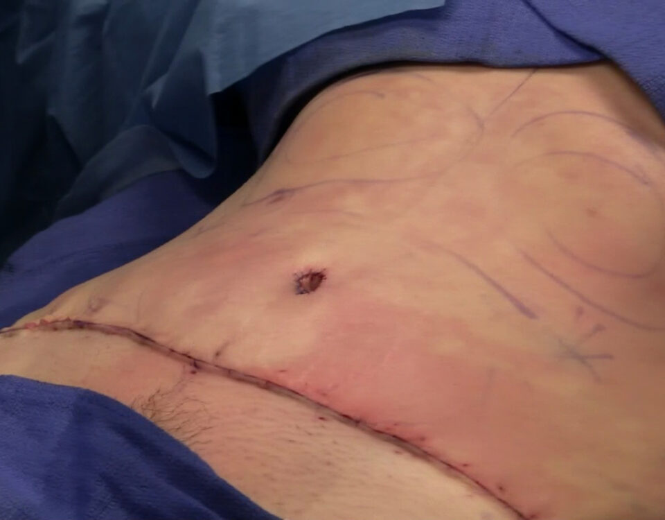 What to Expect During a Tummy Tuck Procedure