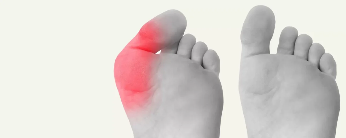 Why Bunions Happen and How To Prevent Them