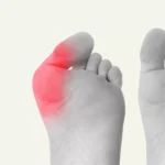 Why Bunions Happen and How To Prevent Them