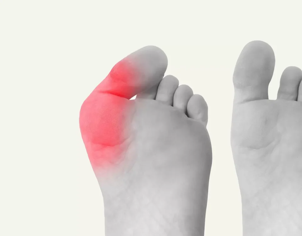 Why Bunions Happen and How To Prevent Them