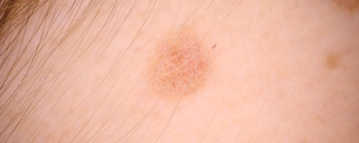 How Seborrheic Keratosis Differs from Other Skin Conditions