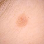 How Seborrheic Keratosis Differs from Other Skin Conditions