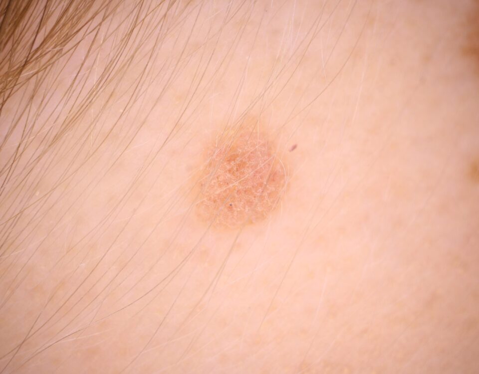 How Seborrheic Keratosis Differs from Other Skin Conditions