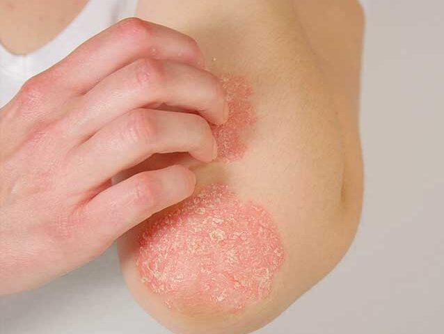 How Skin Doctors Diagnose and Treat Eczema