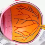 Common Misconceptions About Glaucoma