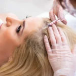 Exploring the Role of PRP in Hair Restoration Treatments