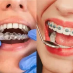 How Invisalign Aligners Work to Straighten Your Teeth
