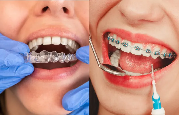 How Invisalign Aligners Work to Straighten Your Teeth