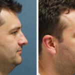 How a Deviated Septum Can Affect Your Overall Well-being