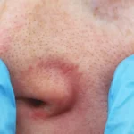 How to Prepare for Spider Vein Removal Treatments