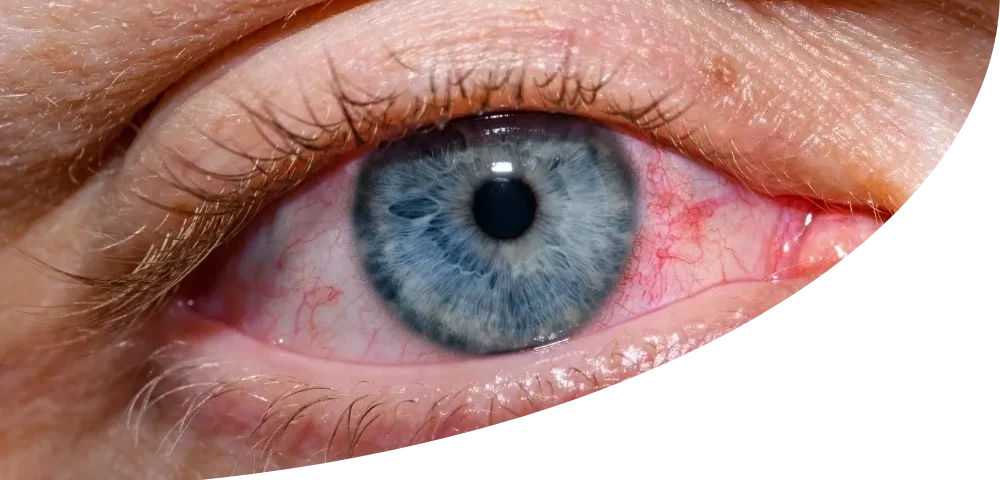 Lifestyle Changes and Treatment Options for Managing Glaucoma