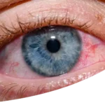 Lifestyle Changes and Treatment Options for Managing Glaucoma