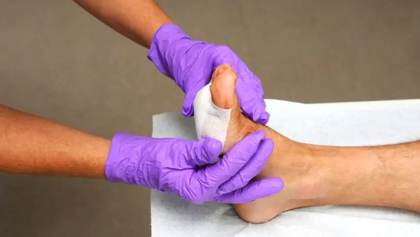 Preventing Complications in Diabetic Foot Care
