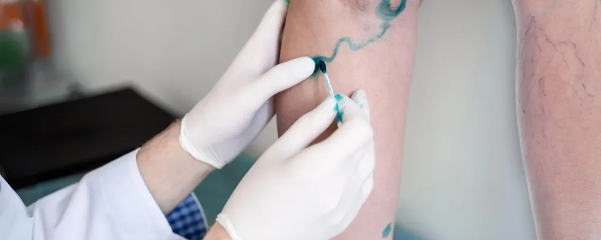 Prevention and Treatment Options for Varicose Veins