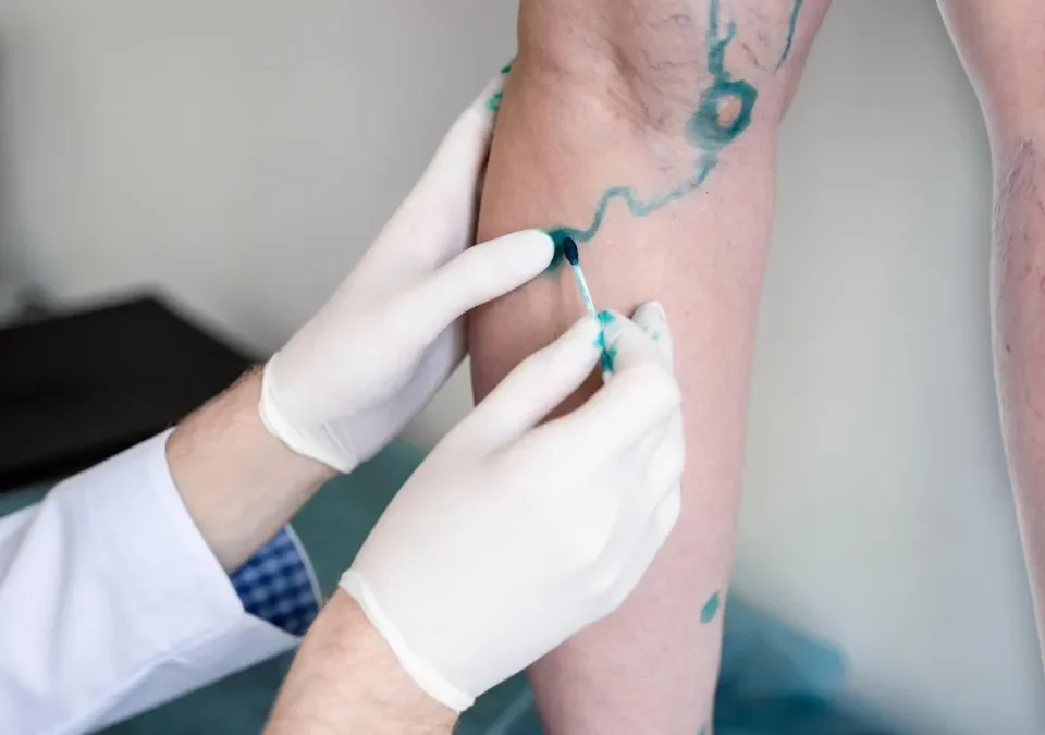 Prevention and Treatment Options for Varicose Veins