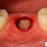 Recovery Tips After Oral Surgery