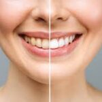 Tailoring Cosmetic Dentistry Treatments to Different Needs