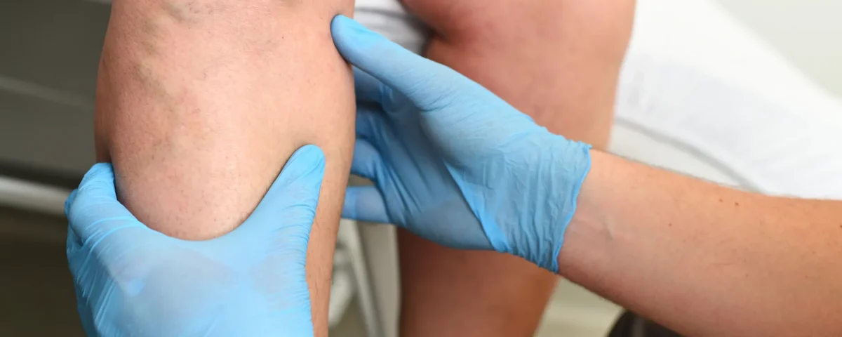 The Connection Between Stress Tests and Spider Veins