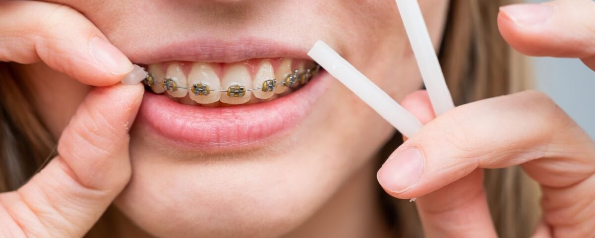 What To Expect When Getting Braces