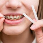 What To Expect When Getting Braces