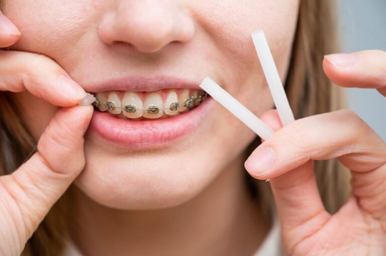 What To Expect When Getting Braces