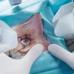 The Latest Advances in LASIK Surgery Technology