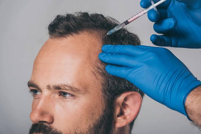 Benefits of PRP Hair Restoration for Thinning Hair