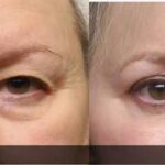 FAQs About Mohs Surgery
