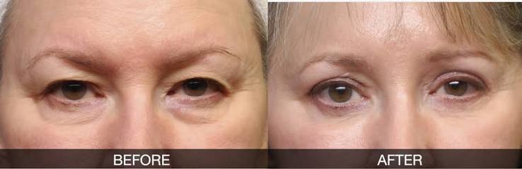 FAQs About Mohs Surgery
