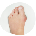 How a Foot Doctor Can Diagnose and Treat Bunions