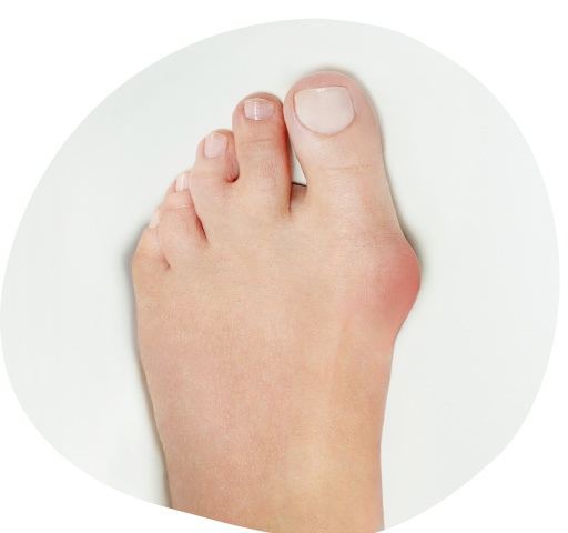 How a Foot Doctor Can Diagnose and Treat Bunions