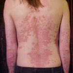 Identifying Skin Conditions That May Be Related to Allergies
