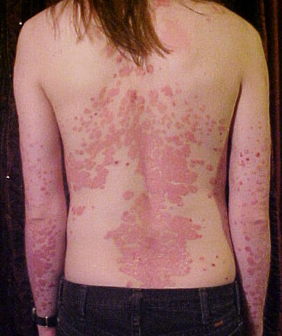 Identifying Skin Conditions That May Be Related to Allergies